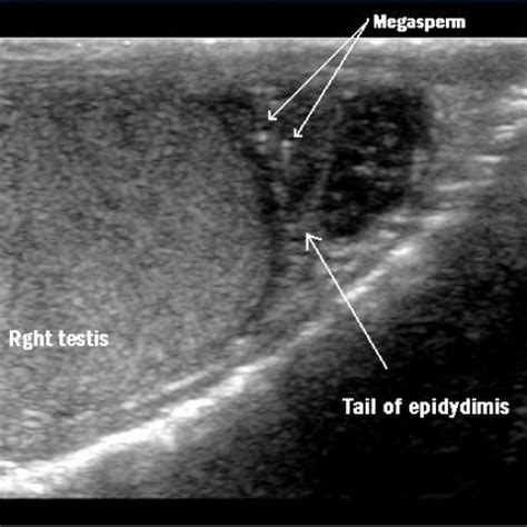 dancing sperm|IMAGES IN CLINICAL RADIOLOGY Dancing .